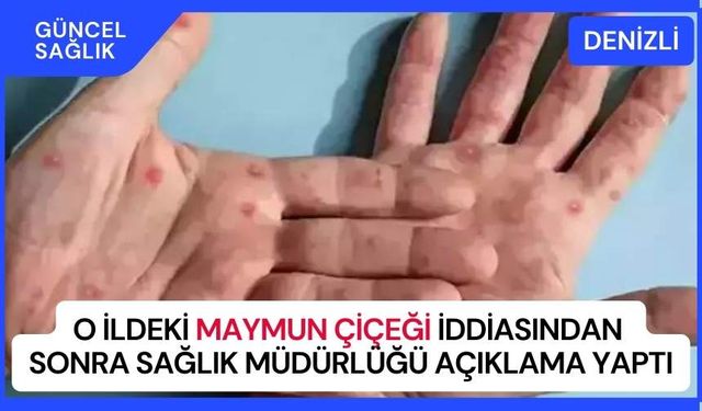 O ilde yayılan maymun çiçeği vakası iddiası netleşti