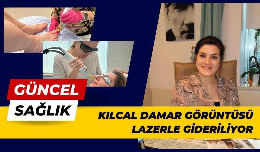 Kılcal Damarlar ve Varisler Lazerle Tedavi Ediliyor. En Uygun Mevsim Kış