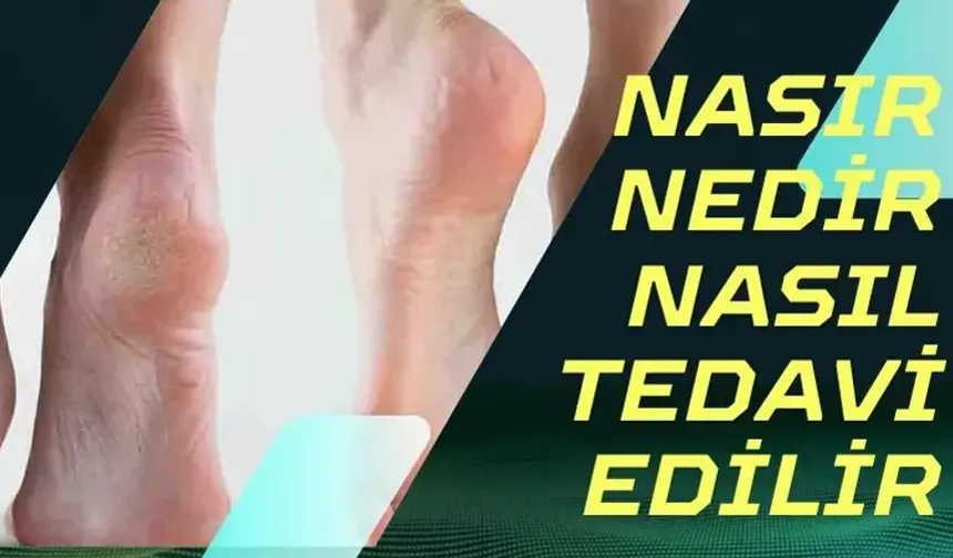 Nasır Nedir? Nasıl Tedavi Edilir? / Yararlı Bilgiler